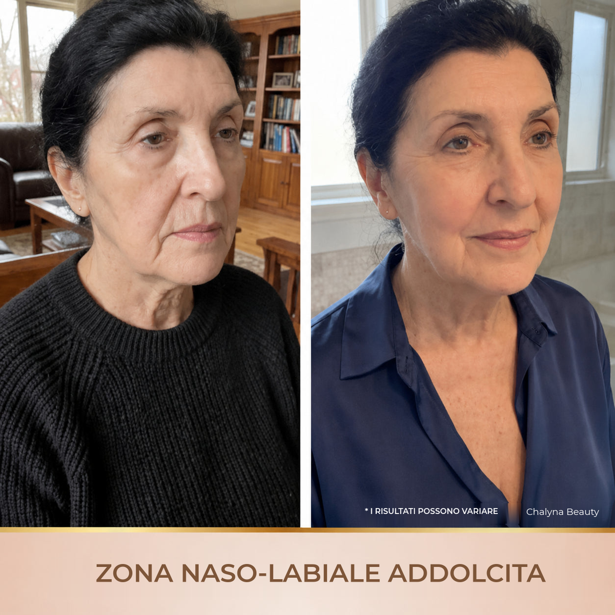 Zona naso-labiale addolcita